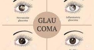 Glaucoma